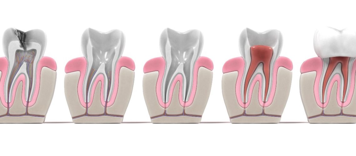Root Canal